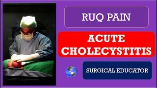 ACUTE CHOLECYSTITIS How To DIAGNOSE amp TREAT  RUQ PAIN [upl. by Hodgkinson]