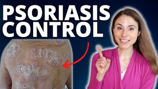 TOP 5 TIPS TO CONTROL PSORIASIS FLARES 😊 DERMATOLOGIST DrDrayzday [upl. by Aliwt55]