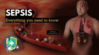 Sepsis Everything You Need to Know [upl. by Akayas]