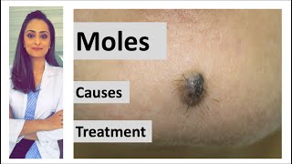 How to remove a mole  Mole causes amp removal  home remedy  Dermatologist  Dr Aanchal Panth [upl. by Shae358]