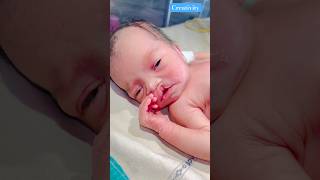 Newborn Cleft Lipmedical newbornbaby viralvideo [upl. by Wilhelmine437]