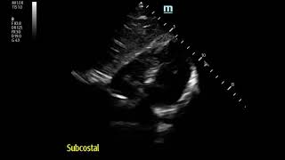 Severe Pleuritic MidChest Pain in 17 yo Boy Pneumomediastinum [upl. by Ardnak]