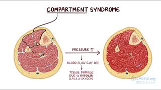 Compartment Syndrome [upl. by Ganiats]