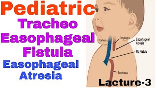 Tracheoesophageal fistula in hindiEsophageal Atresia  TEF EA  staff nurse online classes [upl. by Schuyler]