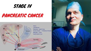 Pancreatic Cancer Stage 4 [upl. by Daven]