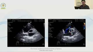 Approach to Congenital Cyanotic Heart Disease in neonatal period  Dr M Venkatesh [upl. by Akimihs]