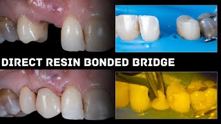 Direct Resin Bonded Bridge [upl. by Mcloughlin744]