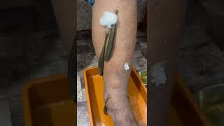 Can leeches remove blood clots leechtherapyswellingvaricoseveinspainskinskincarelegpaindr [upl. by Lilian]