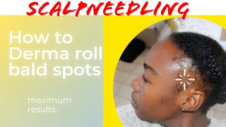 How to Derma roll BALD spots amp edges for MAXIMUM HAIR growth Natural Hairline regrowth [upl. by Eikciv]