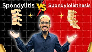 spondylitis vs spondylolisthesis  spondylitis  Spondylolisthesis  everything you need to know [upl. by Aidam176]