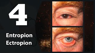 4 Eye lids Entropion amp Ectropion [upl. by Eberta]