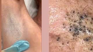 Ingrown hair  Ingrown hair removal  Pimple popping [upl. by Eednac]