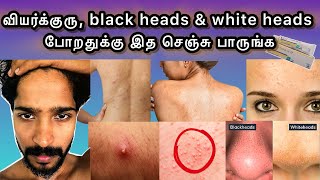 Summer Heat 🥵 Pimples Remady  Tips For Clear Skin  தமிழ் [upl. by Nomra]