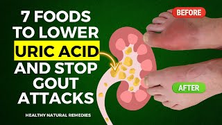 7 Incredible Foods To Lower Uric Acid and Stop Gout Attacks [upl. by Leinod]