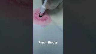 Punch Biopsy Technique doctor hospital [upl. by Acirre]