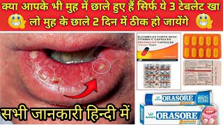 सिर्फ ये टेबलेट खा लो मुह के छाले 1 दिन मेें ठीक हो जायेंगे  Stomatitis Treatment in hindi  Ulcer [upl. by Tracay539]