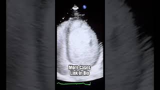 Reverse Takotsubo Cardiomyopathy echocardiography [upl. by Aniloj]