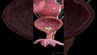 🪨 Bladder Stones What You Need to Know 🪨 anatomy [upl. by Hungarian637]