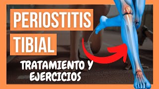 🦵PERIOSTITIS TIBIAL 💥 Qué es Causas Ejercicios y Tratamiento [upl. by Mayberry202]