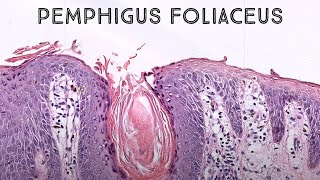 Pemphigus foliaceus autoimmune skin blister immunobullous disease in pemphigus vulgaris family [upl. by Aerdnaxela]