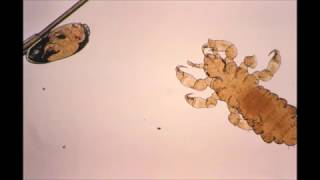 Pediculosis Head and body lice [upl. by Apostles]