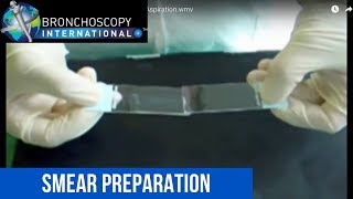 Smear Preparation after Bronchoscopic Needle Aspiration [upl. by Neehar]