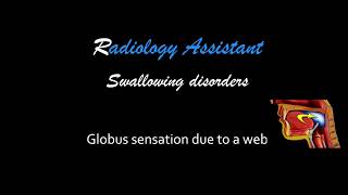 Swallowing disorders  Web causing globus sensation [upl. by Serles]