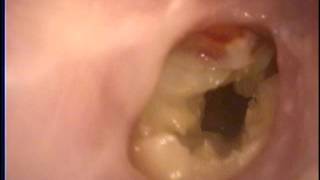 中耳炎 劉耿僚醫師 right ear COM earwax otorrhea Dr KenLiao Liu [upl. by Pedaias]