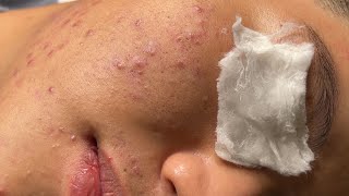 Blackheads amp Whiteheads Removal New 2024  Acne Treatment With Bo Nguyễn Spa 033 [upl. by Krauss692]