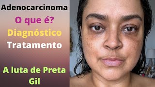 Adenocarcinoma o que é o câncer descoberto por Preta Gil sintomas e como é o diagnóstico [upl. by Arytahs]