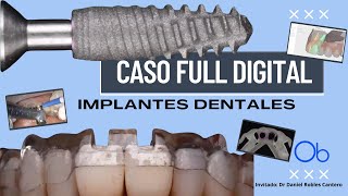 Caso clínico FULL DIGITAL de implantes dentales anteriores con Dr Daniel Robles Cantero [upl. by Nnylecyoj]