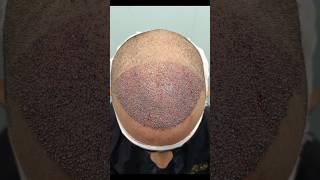 3000 grafts Hair Transplant for Hairline Restoration [upl. by Swerdna]