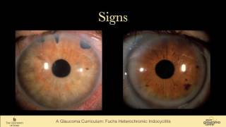 25 SECONDARY GLAUCOMAS Fuchs Heterochromic Iridocyclitis [upl. by Metzgar]