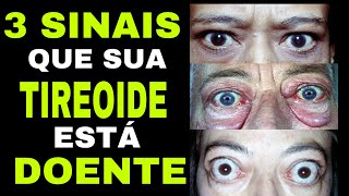 3 SINAIS NO SEU CORPO QUE A TIREOIDE ESTÁ DOENTE Hipertireoidismo [upl. by Enyamrahc]