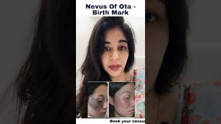 Dermatologist Dr Anvika Reveals The Solution Of Nevus Of Ota [upl. by Waite]