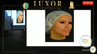 Mesobotox by Dr Sara Mohy [upl. by Htiffirg]