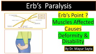 Erbs Paralysis [upl. by Kappel]