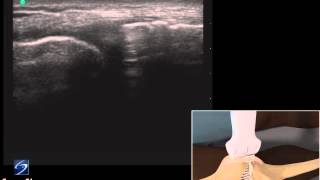 How To Ultrasound Exam of the Medial Collateral Ligament 3D Video [upl. by Dunaville]