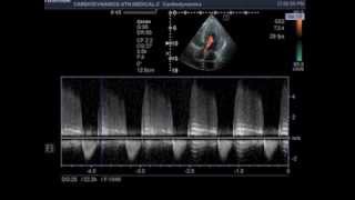 aortic regurgitation [upl. by Tuesday447]