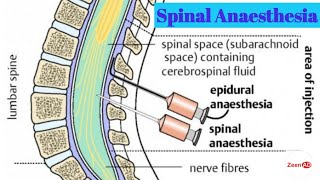 Spinal AnesthesiaProcedure Of Spinal AnesthesiaAdvantages And Disadvantages Of Spinal Anesthesia [upl. by Ramses]