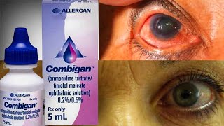 Combigan Eye Drop For Ocular Hypertension glaucoma  Brimonidine  Timolo [upl. by Ilrebmik]