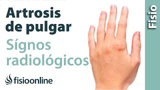 Rizartrosis o artrosis del pulgar  Signos radiológicos [upl. by Avra]