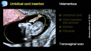 Velamentous insertion of the umbilical cord [upl. by Assenab]