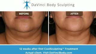 WOW Stunning CoolSculpting Chin Results [upl. by Enirhtak]