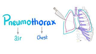 Pneumothorax  Spontaneous vs Tension Pneumothorax  Lung Physiology  Pulmonary Medicine [upl. by Doralia]