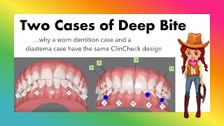 Invisalign ClinCheck  2 cases for 1 KEY things to know for any lower arch crowding [upl. by Voltmer397]