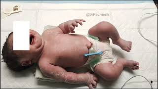 Medical Education Video Neonatology Neonatal Brachial Plexus Palsy Erb Palsy [upl. by Oiramed219]