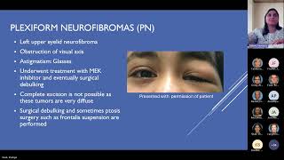 Pediatric Manifestations of Neurofibromatosis Type 1 Pediatric Grand Rounds Meeting 11 15 24 [upl. by Tanaka368]