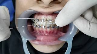 Orthodontic Ligation [upl. by Dnartreb98]