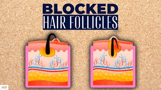 Blocked Hair Follicle – Everything You Need To Know [upl. by Tisbe410]